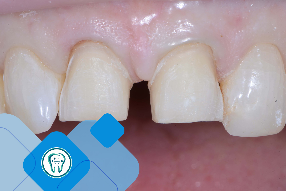 لمینت دندان برای چه مواردی ترجیح داده می شود؟