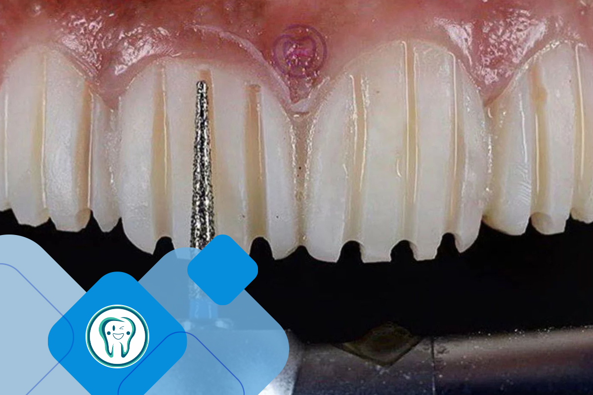 لمینت یا ونیر دندان: چه چیزی برای من مناسب است؟