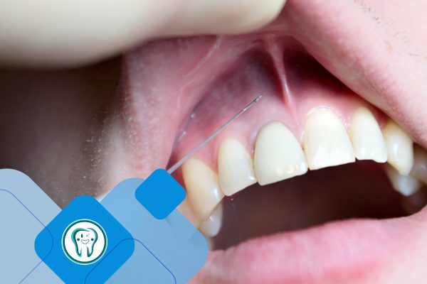 اسید هیالورونیک در دندانپزشکی