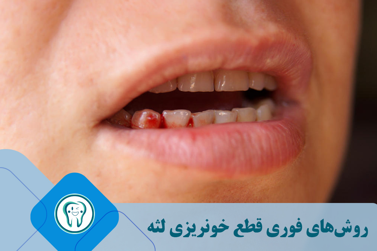 روش‌های فوری قطع خونریزی لثه