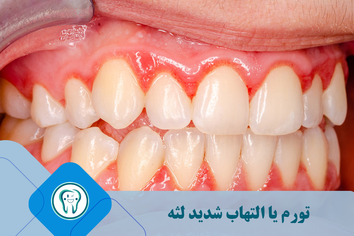 تورم یا التهاب شدید لثه