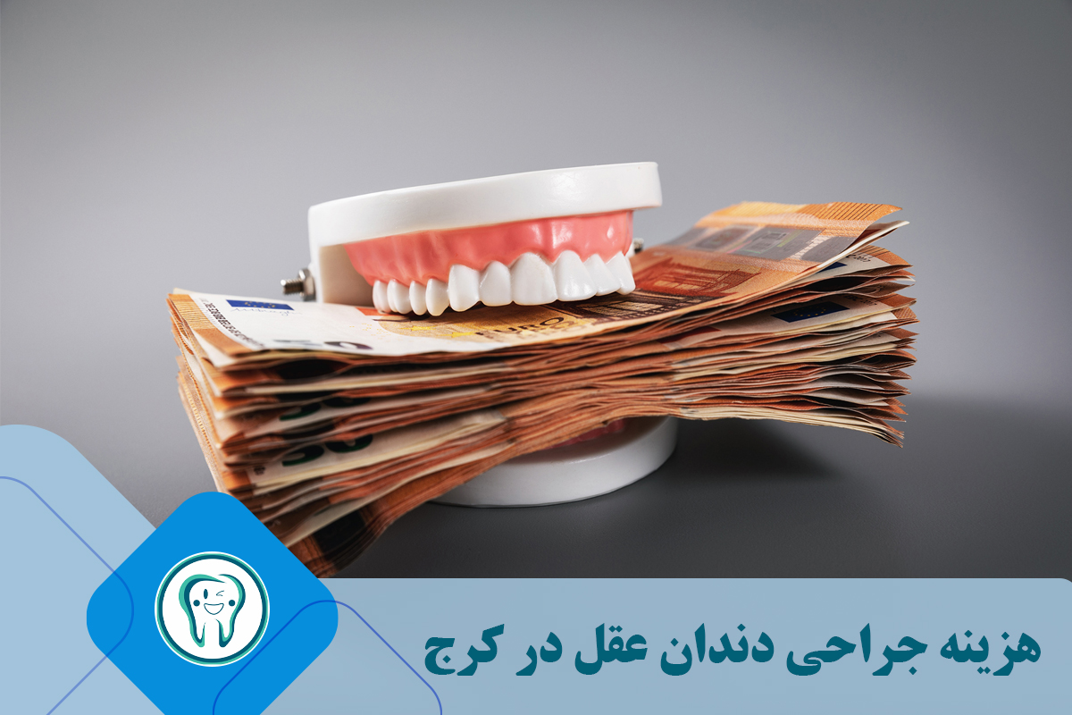 هزینه جراحی دندان عقل در کرج