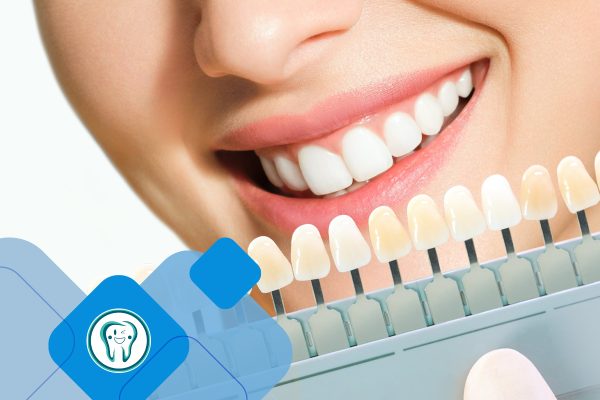 لمینت دندان قسطی در کرج