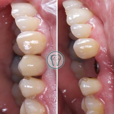 نمونه درمان متخصص ایمپلنت در کرج