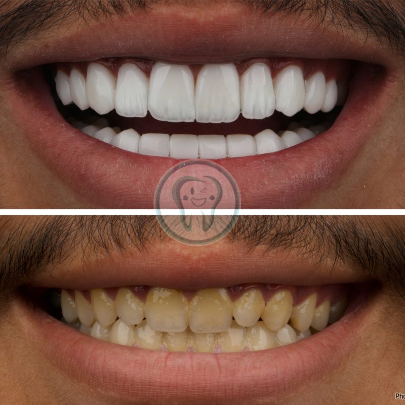 Composite-veneer-treatment-1
