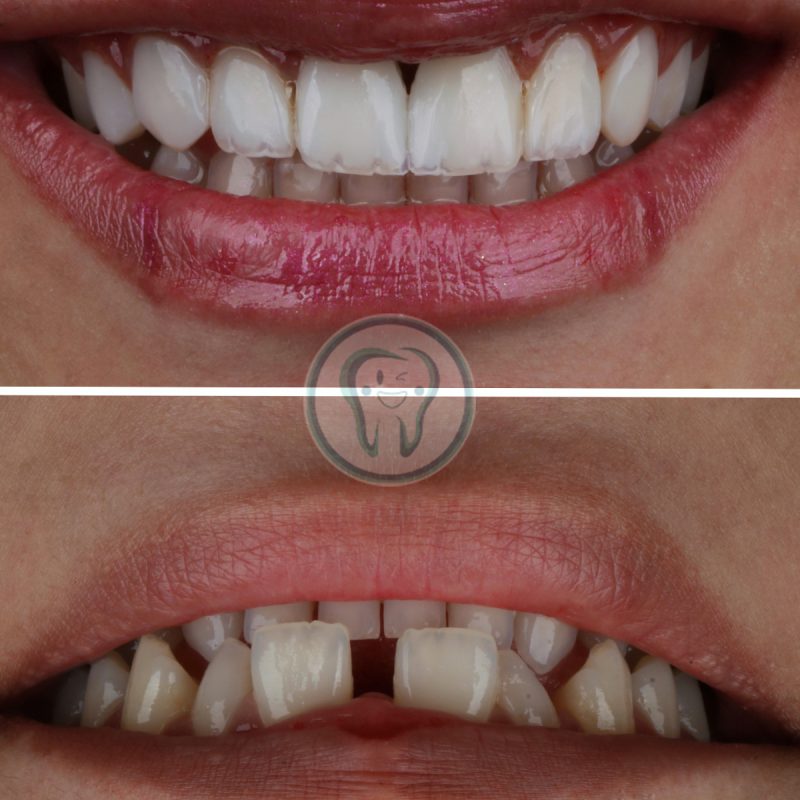 Composite-veneer-treatment-2