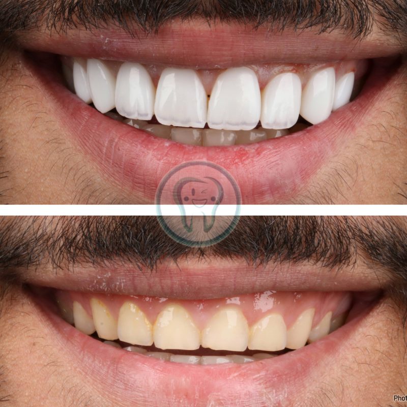 Composite-veneer-treatment-at-Quds-Clinic