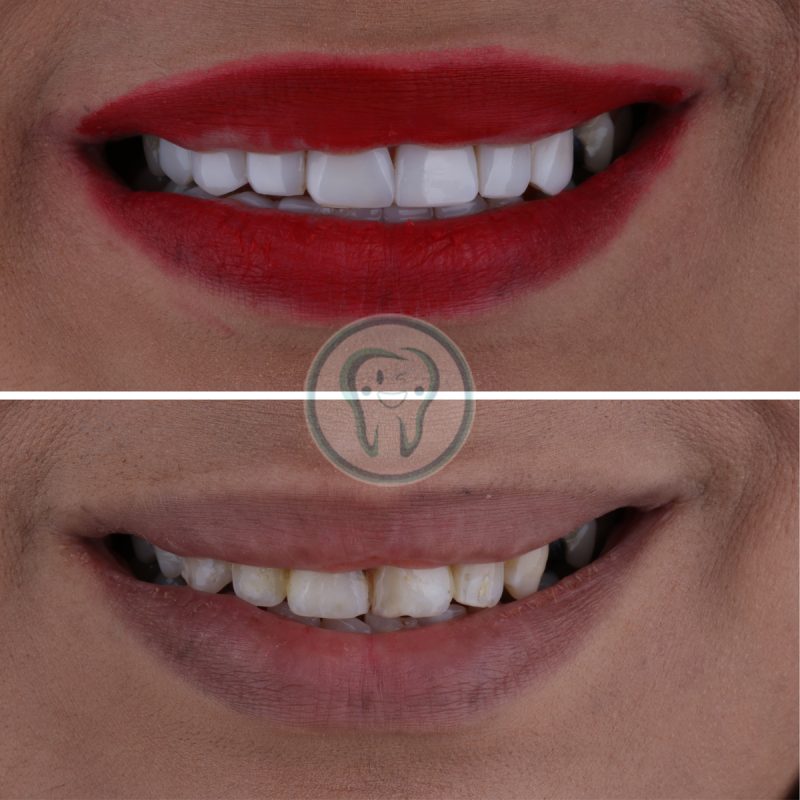 Example-of-composite-veneer-treatment
