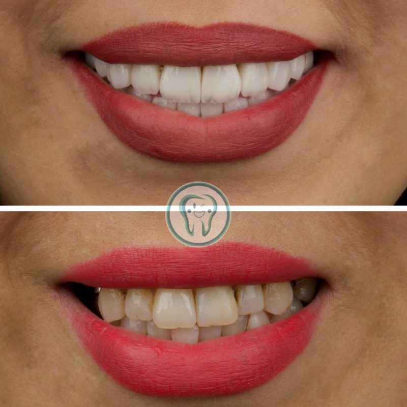 Example-of-dental-composite-treatment-in-Karaj