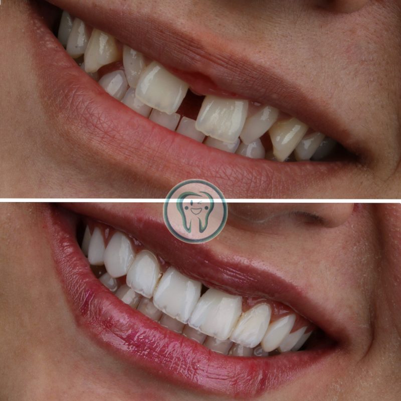 Example-of-dental-laminate-treatment-in-Karaj