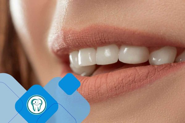مقالات 73 ارتباط لمینت و پوسیدگی دندان