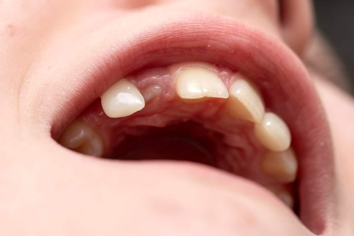 child showing knocked out tooth