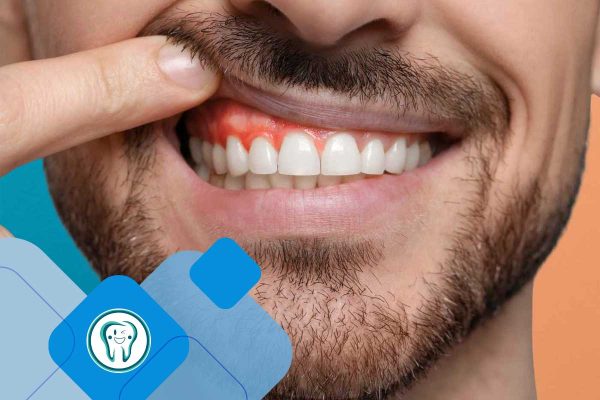 مقالات 49 آبسه دندان