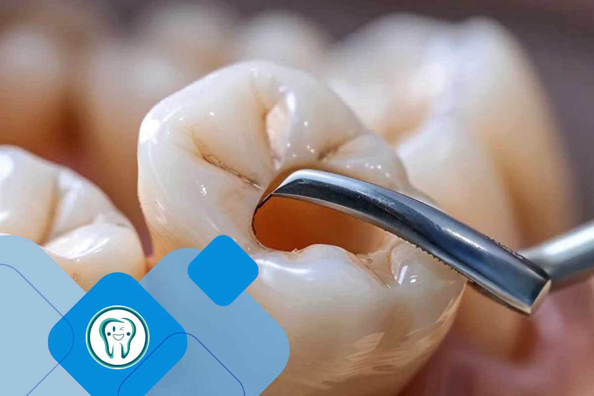 فرق کشیدن دندان با جراحی