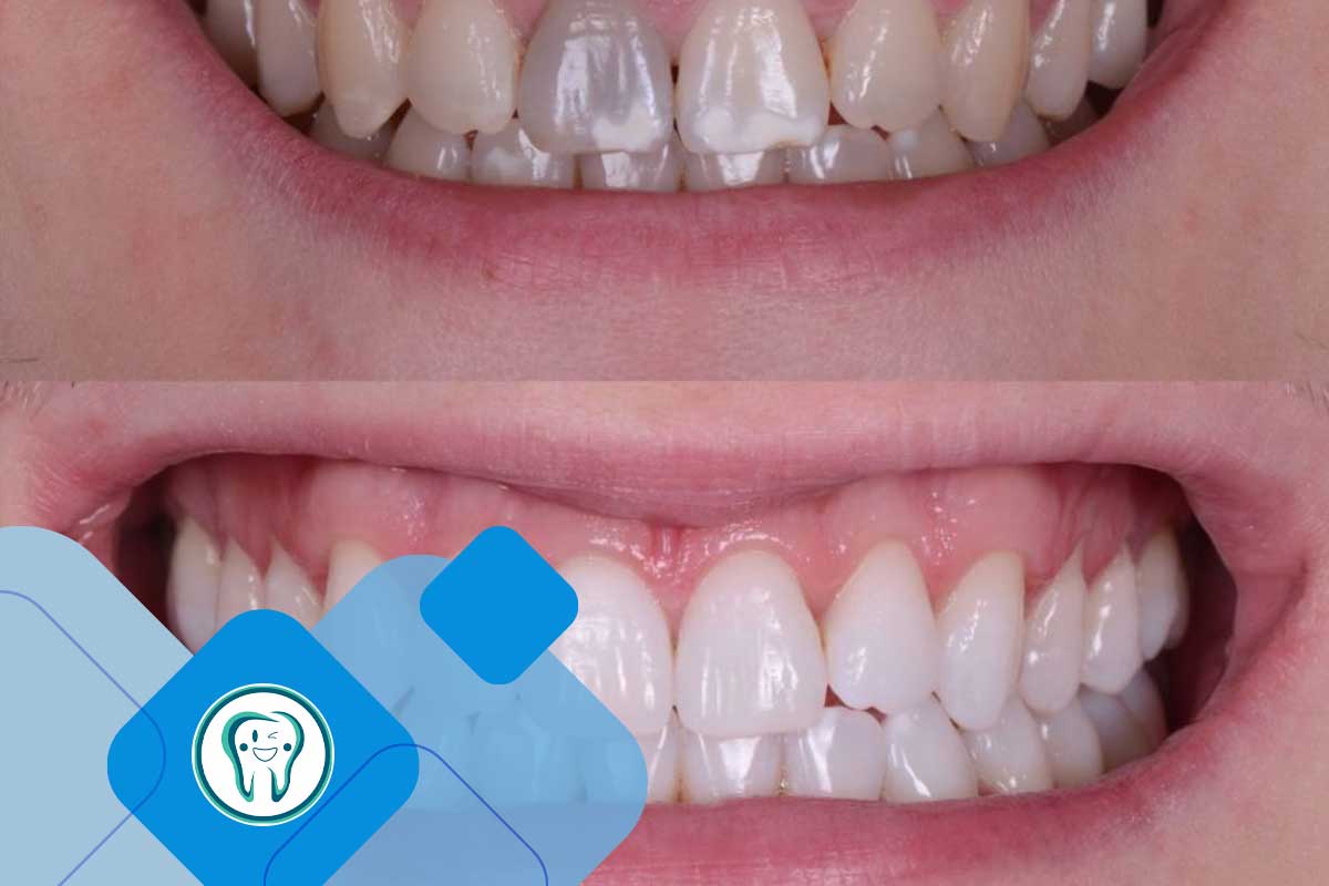 عکس قبل و بعد بلیچینگ دندان اقساطی