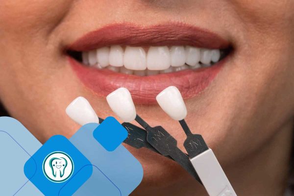 تفاوت بلیچینگ و لمینت دندان