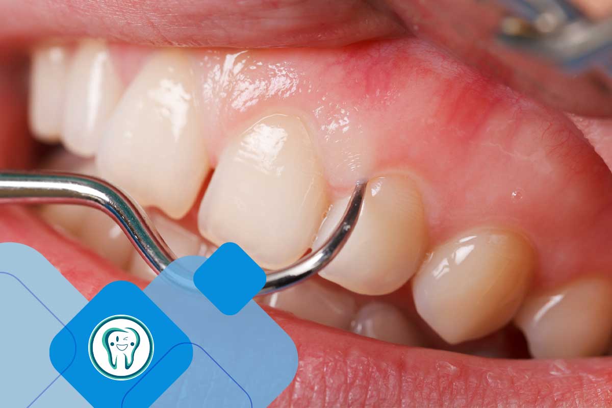 مزایای لیفت لثه در کرج 