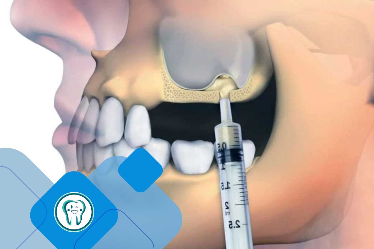 انواع جراحی سینوس لیفت 