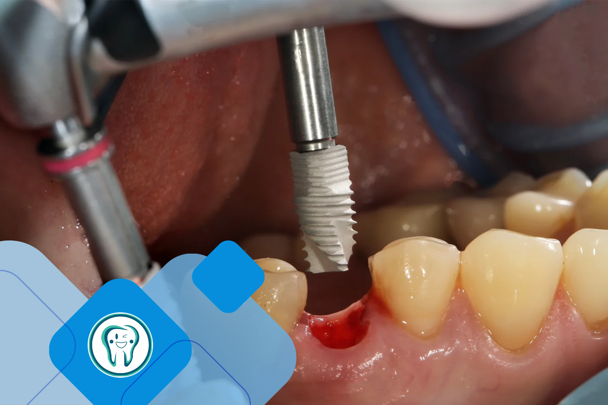 Benefits of choosing an installment plan for dental implants