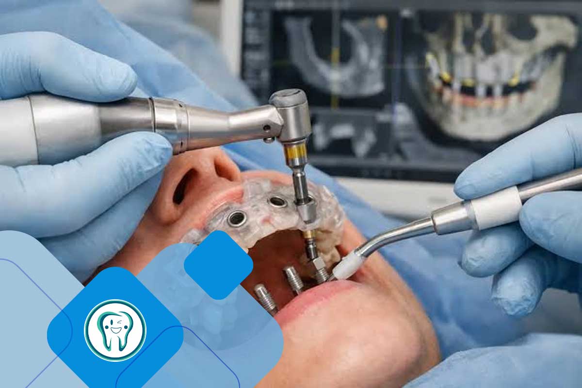 گاید جراحی ایمپلنت دیجیتال