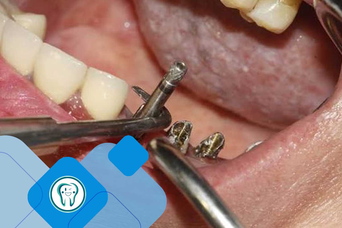 خارج کردن ایمپلنت