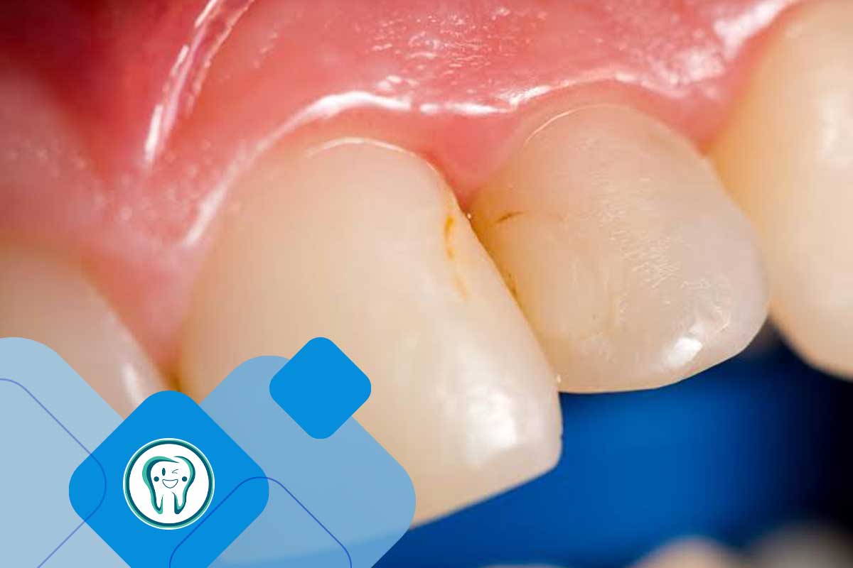 تفاوت ریزنشت کامپوزیت با تغییر رنگ و پوسیدگی اطراف کامپوزیت