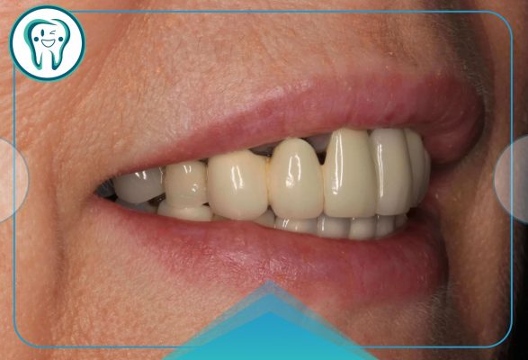 مقالات 60 مشکلات بریج دندان