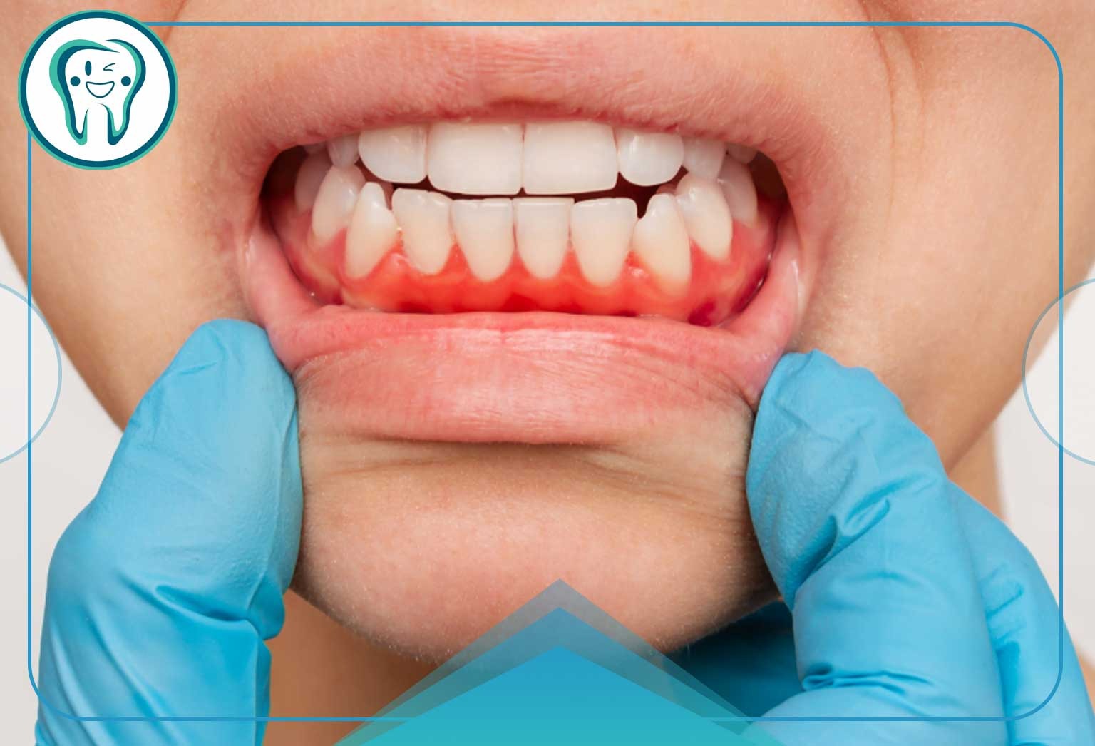 لثه درد عصبی؛ وقتی استرس دندانهایتان را هدف میگیرد (علائم و درمان قطعی) 2 imageye imgi 22 Neuralgic gum pain
