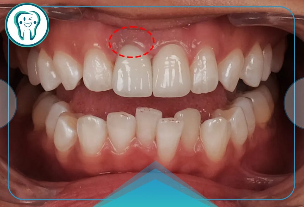 imageye imgi 26 Complications of dental veneers 1024x697 1