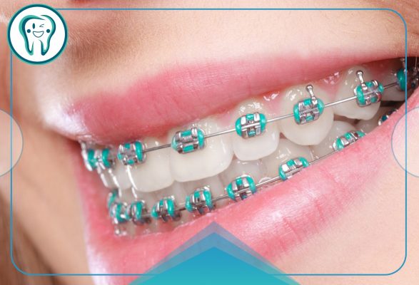 imgi 12 Colored orthodontics