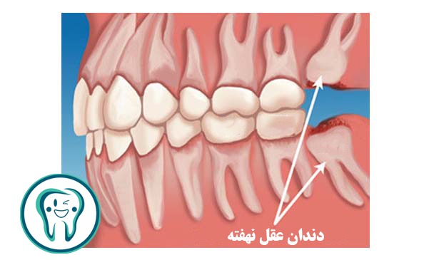 دندان عقل کجاست؟ راهنمای کامل علائم، درد و زمان کشیدن 1 imgi 22 Where is the wisdom tooth