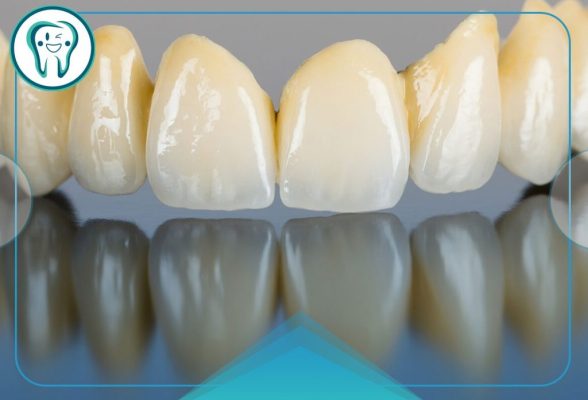 مقالات 56 گذاشتن دندان مصنوعی