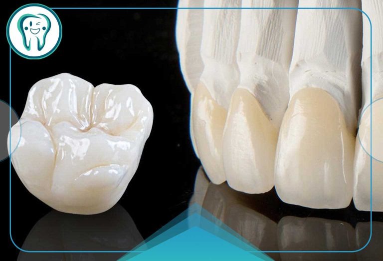چرا تراش دندان برای روکش سرامیکی ضروری است؟ 7 imgi 9 قالب سایت قدسeerxvwvbtrffvrervc 768x523 1