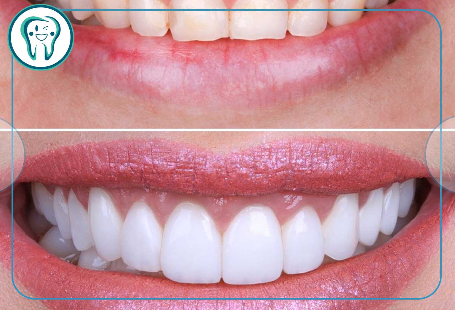 چرا تراش دندان برای روکش سرامیکی ضروری است؟ 3 قالب سایت قدسemax veneer