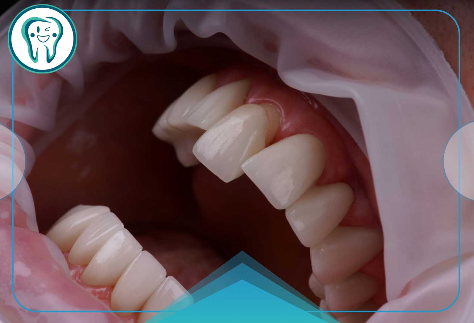 چرا تراش دندان برای روکش سرامیکی ضروری است؟ 1 قالب سایت قدسsrtbfwecdwefrtbtswec