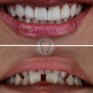راهنمای کامل انتخاب مطب دندانپزشکی زیبایی در شهریار(دندانپزشکی دکتر محسن بیاتی) 3 Composite-veneer-treatment-2