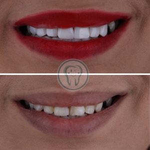 راهنمای کامل انتخاب مطب دندانپزشکی زیبایی در شهریار(دندانپزشکی دکتر محسن بیاتی) 5 Example-of-composite-veneer-treatment