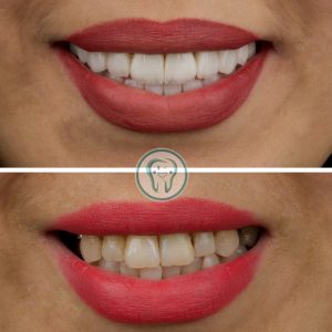 راهنمای کامل انتخاب مطب دندانپزشکی زیبایی در شهریار(دندانپزشکی دکتر محسن بیاتی) 6 Example-of-dental-composite-treatment-in-Karaj