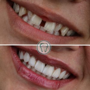 راهنمای کامل انتخاب مطب دندانپزشکی زیبایی در شهریار(دندانپزشکی دکتر محسن بیاتی) 7 Example-of-dental-laminate-treatment-in-Karaj