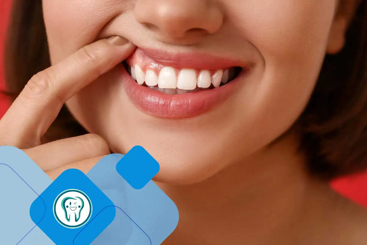 اصلاح لبخند لثه ای با لیزر؛ روش، مزایا و نتایج درمان 5 اصلاح لبخند لثه ای